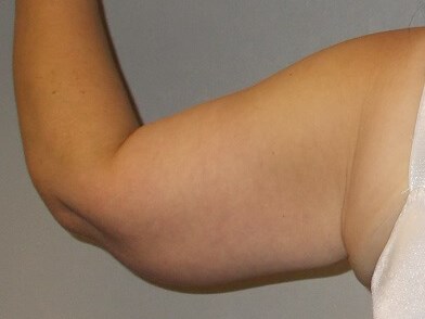 Back View Left Arm After