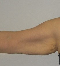 Front View Right Arm Before