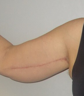 Front View Right Arm After
