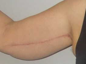 Front View Right Arm After
