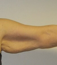 Front View Left Arm Before