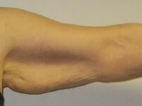 Front View Left Arm Before