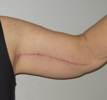 Front View Left Arm After