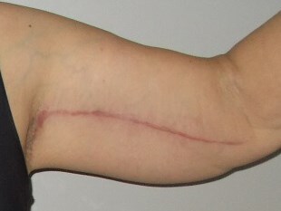 Front View Left Arm After