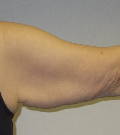 Back View Right Arm Before