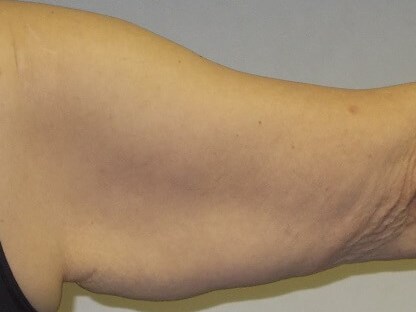 Back View Right Arm Before
