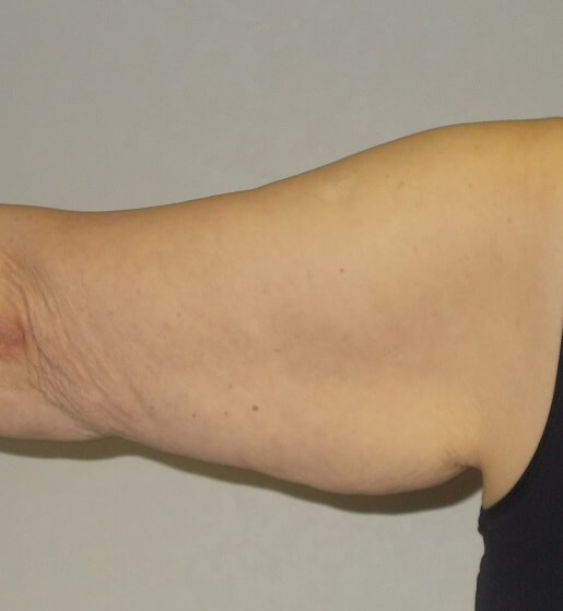 Back View Left Arm Before