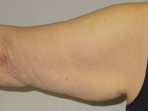 Back View Left Arm Before