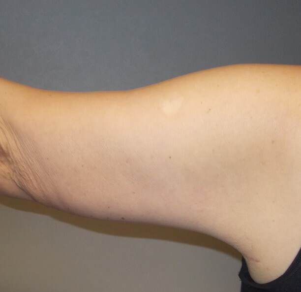 Back View Left Arm After