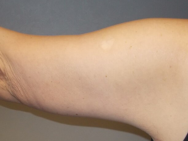 Back View Left Arm After