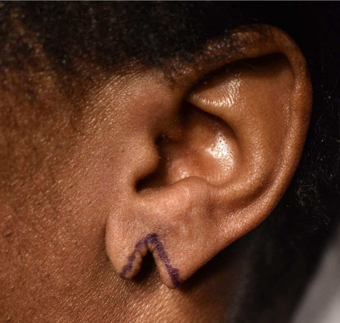 Right Earlobe Before