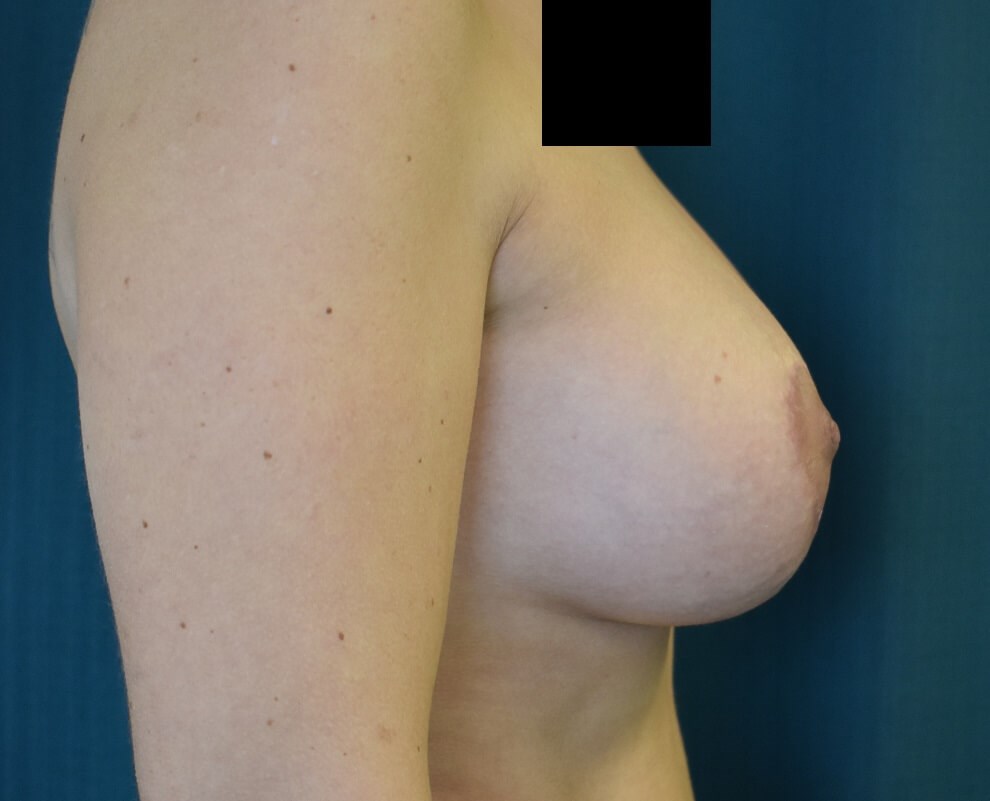 Alternate Side View After