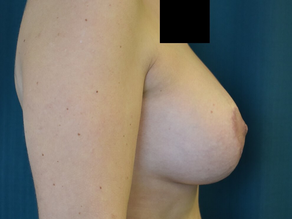 Alternate Side View After