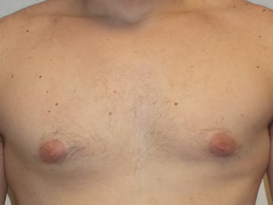 Front View After