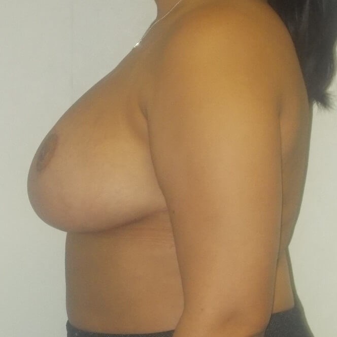 Side View After