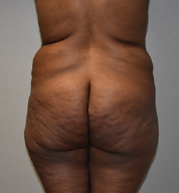 Back View Before