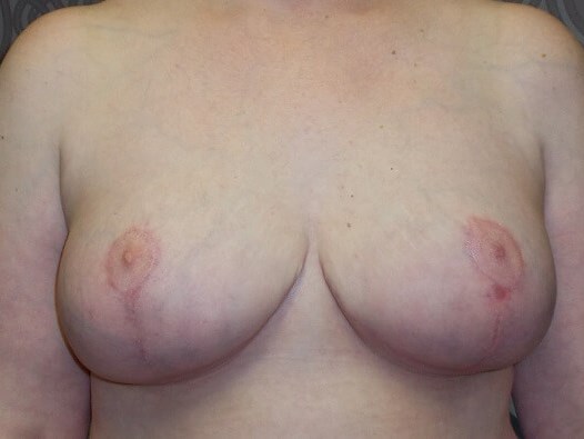 Front View After