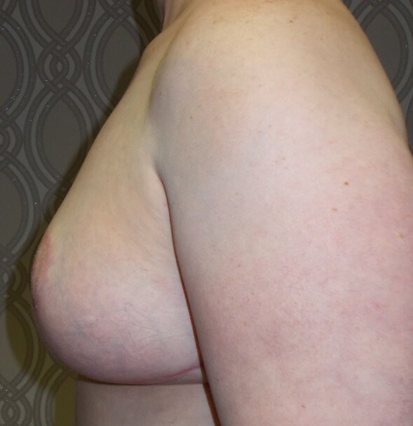 Side View After