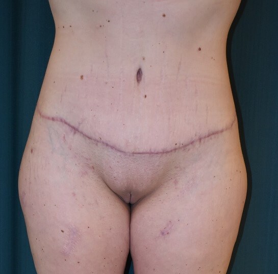 Front View After