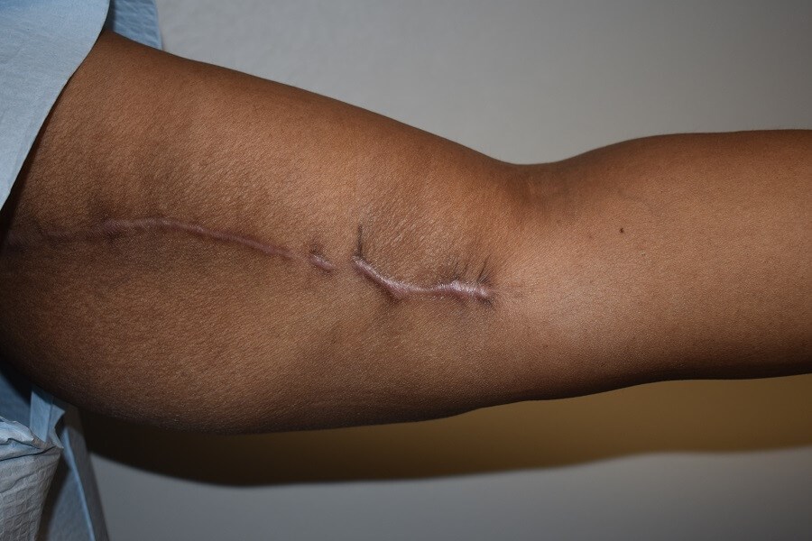 Keloid Scars Before