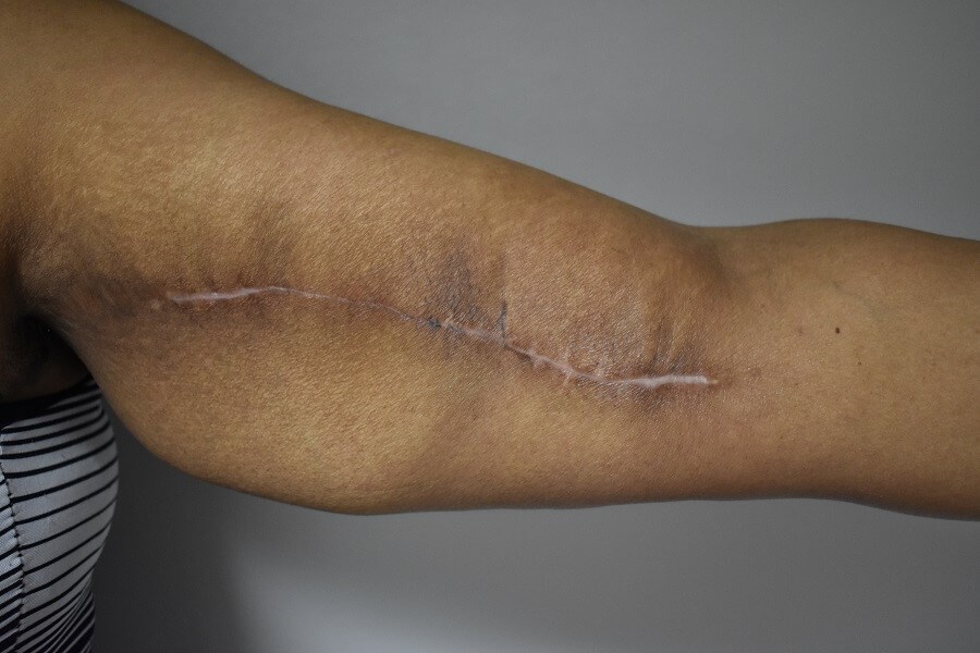 Keloid Scars After