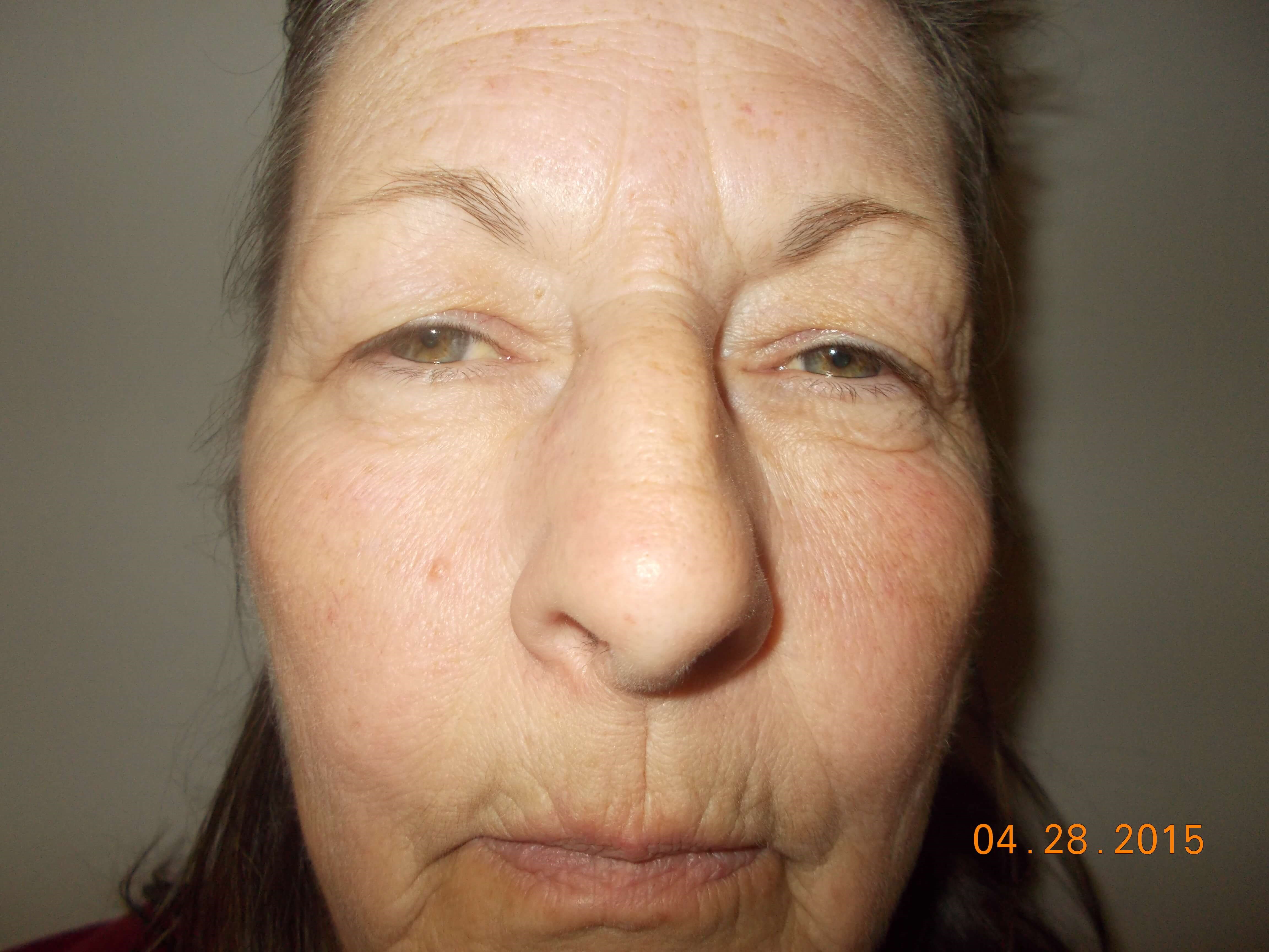 Front View Before