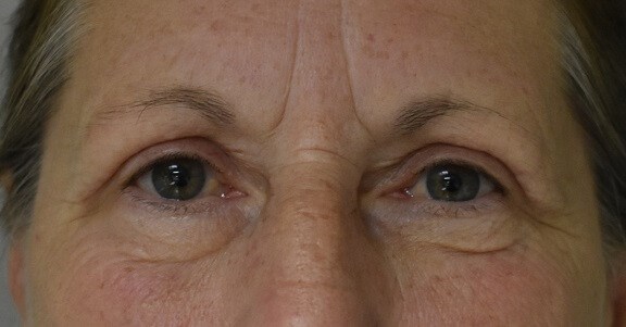 Front View After