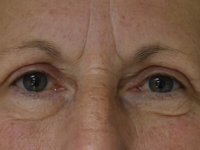 Front View After
