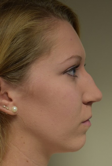 Side View Before