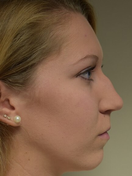 Side View Before