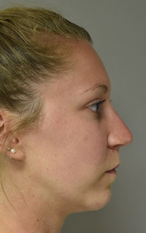 Side View After