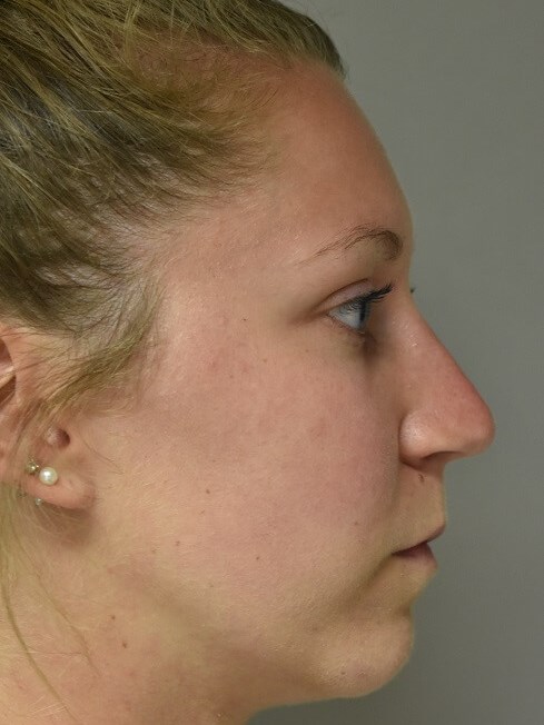 Side View After
