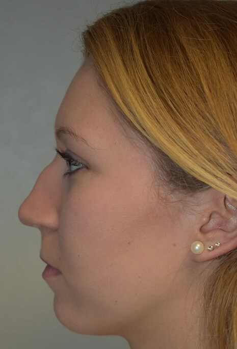 Side View Before