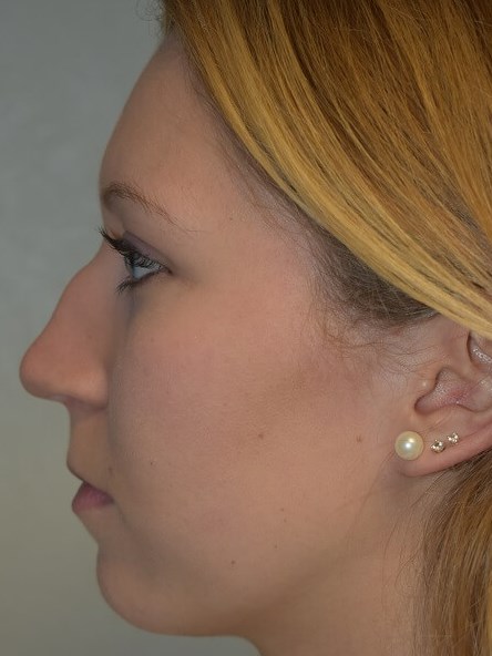 Side View Before