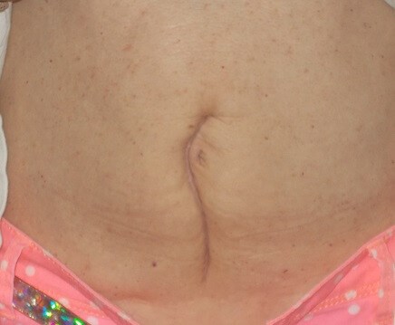Front View Before