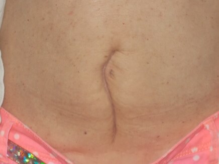 Front View Before