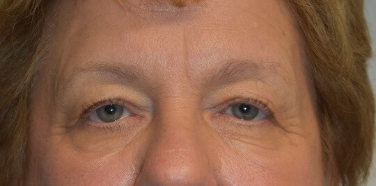 Front View Before