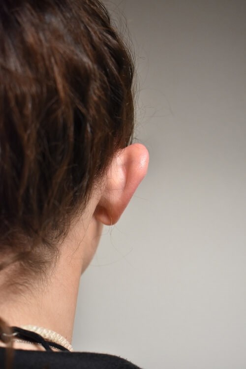 Back View of Right Ear Before