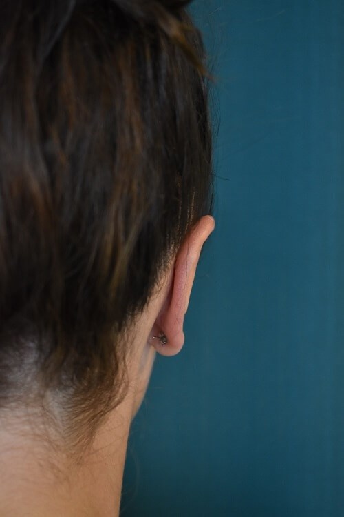 Back View of Right Ear After