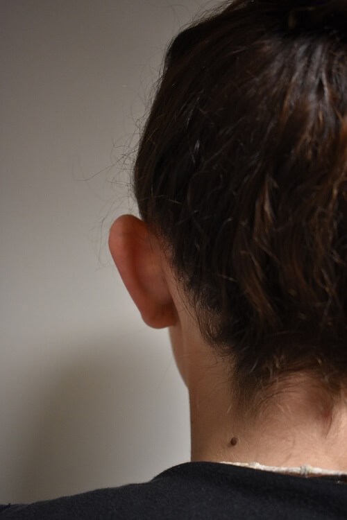 Back View of Left Ear Before