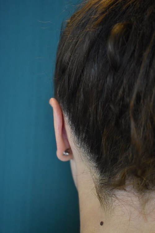 Back View of Left Ear After