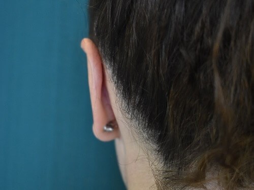 Back View of Left Ear After