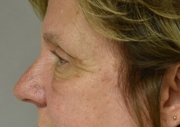 Left Side View After