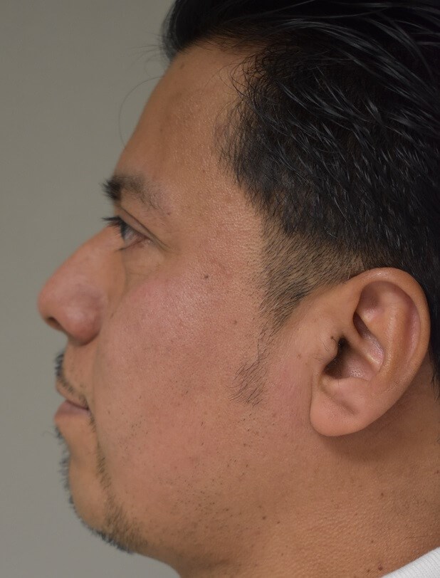 Side View Before