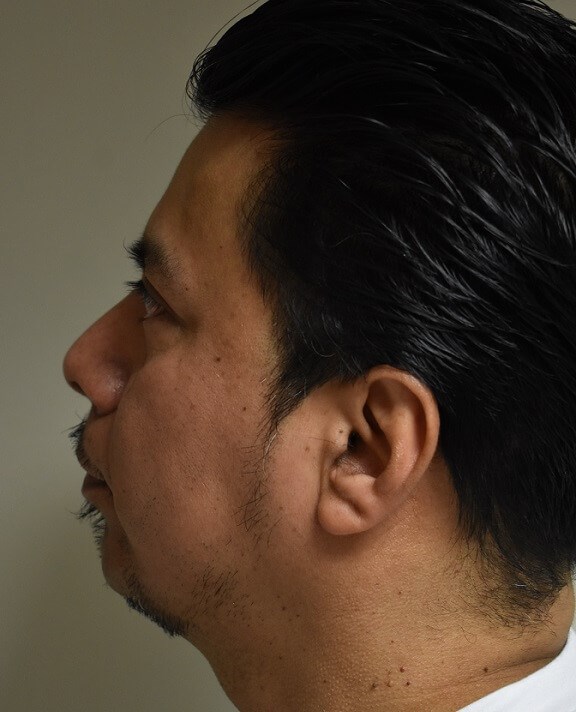 Side View After