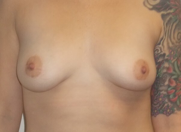 Front View Before