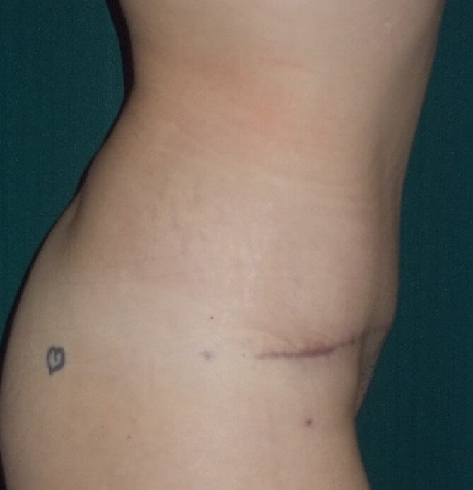 Side View After