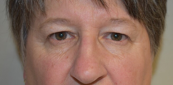 Front View Before