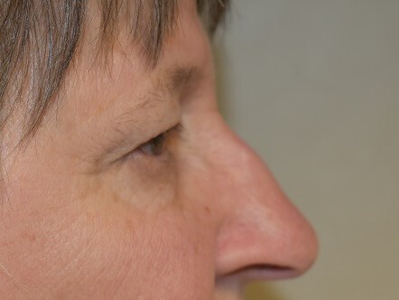 Side View Before