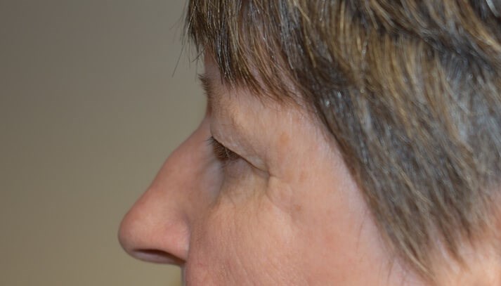 Side View Before